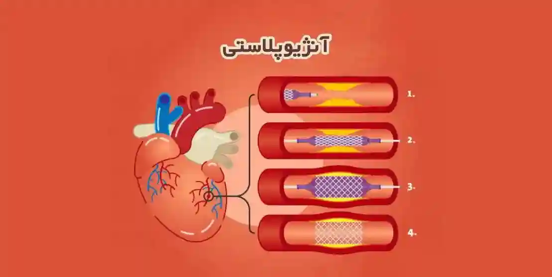 آنژیوپلاستی چیست؟