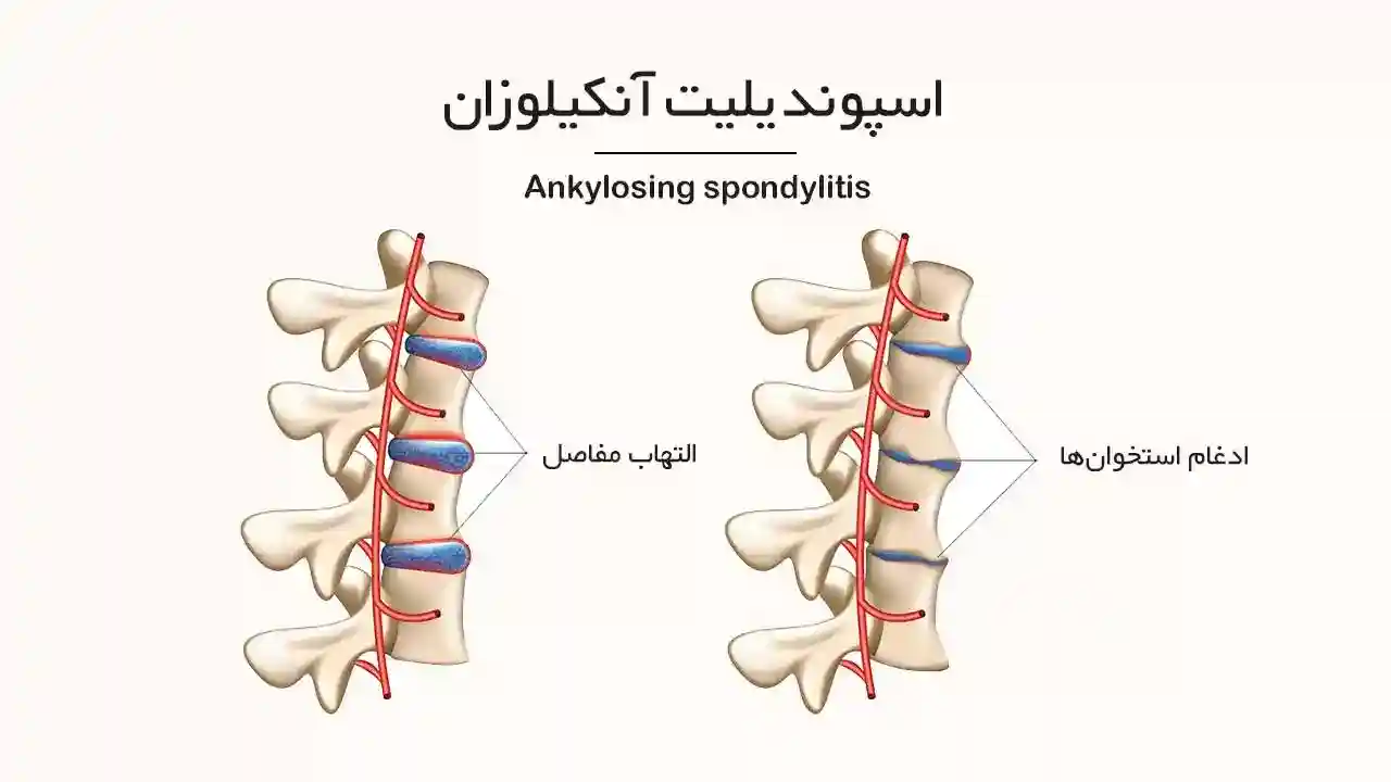 حقایقی که باید درباره اسپوندیلیت آنکیلوزان بدانید