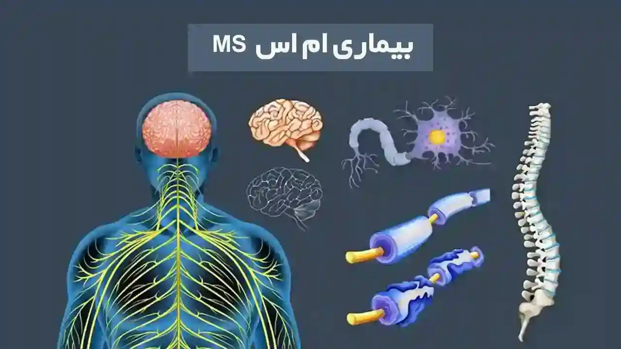 بیماری ام اس یا Multiple Sclerosis چیست؟