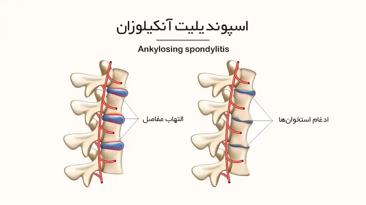 حقایقی که باید درباره اسپوندیلیت آنکیلوزان بدانید - نبض هوشمند سلامت