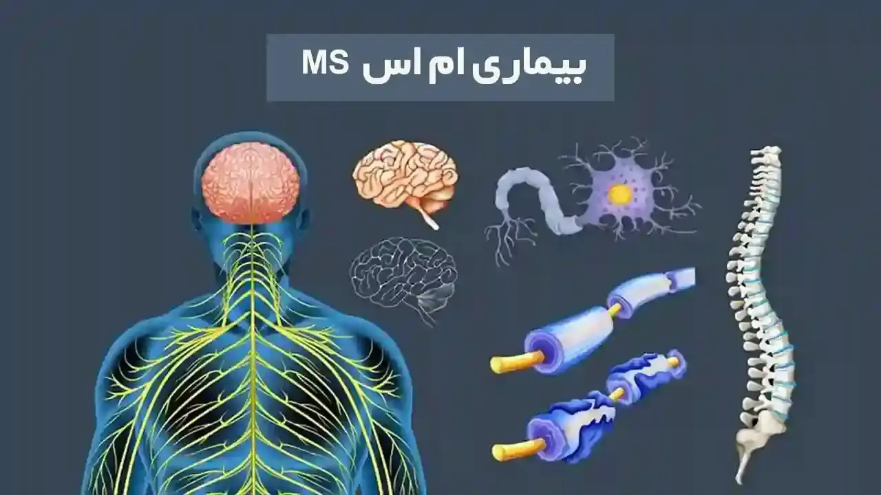 بیماری ام اس یا Multiple Sclerosis چیست؟ - نبض هوشمند سلامت