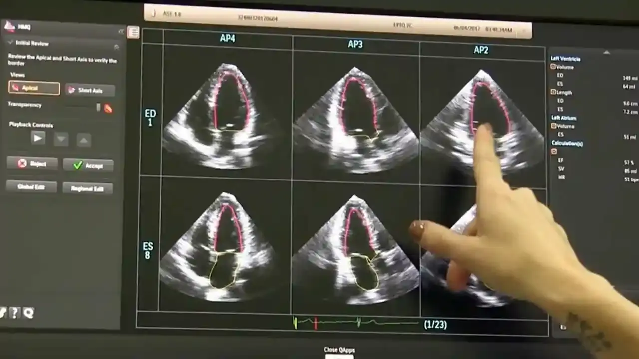 جدیدترین فناوری های اکوکاردیوگرافی با هوش مصنوعی - نبض هوشمند سلامت