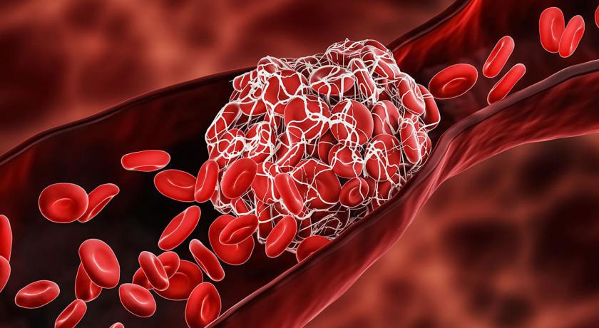 علائم شایع ایجاد لخته خون - نبض هوشمند سلامت