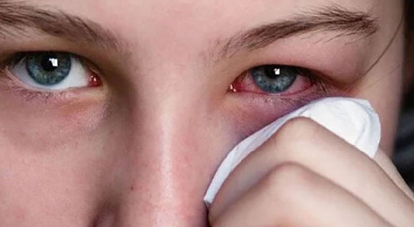 چگونه می توان از قرمزی چشم پیشگیری و آن را درمان کرد؟ - نبض هوشمند سلامت