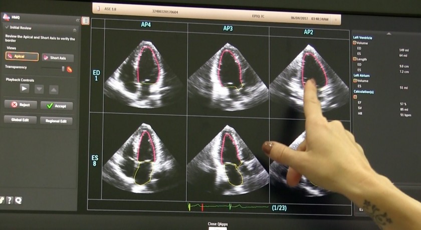 جدیدترین فناوری های اکوکاردیوگرافی با هوش مصنوعی - نبض هوشمند سلامت
